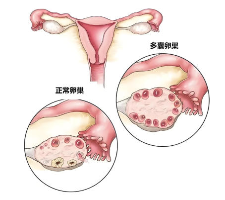 泰安俪人医院卵巢综合症