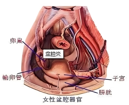 盆腔炎