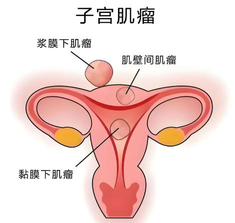 子宫肌瘤