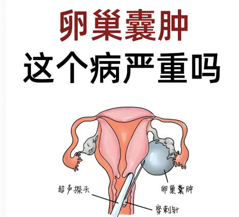 泰安俪人医院卵巢囊肿