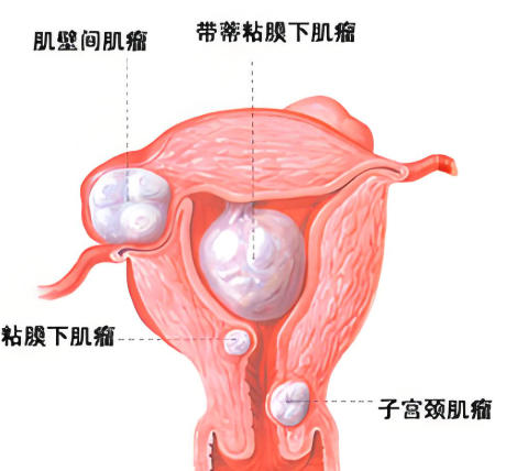 子宫肌瘤2 子宫肌瘤2