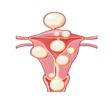 泰安俪人医院子宫肌瘤