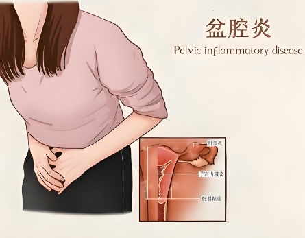 泰安俪人医院盆腔炎