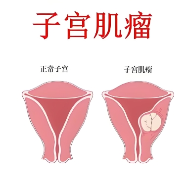 泰安子宫肌瘤