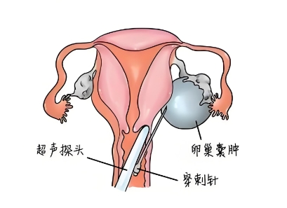 泰安俪人妇产医院子宫囊肿
