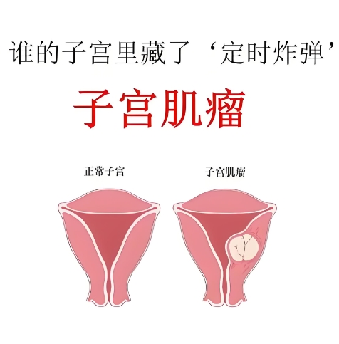 泰安俪人医院子宫肌瘤