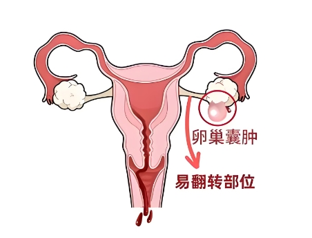 卵巢囊肿
