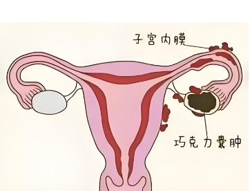 泰安俪人医院卵巢囊肿