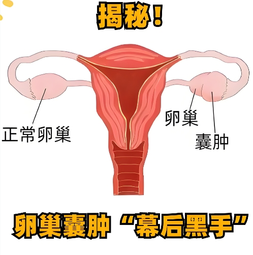 泰安卵巢囊肿