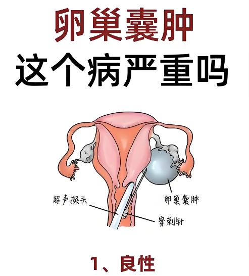 泰安俪人医院卵巢囊肿