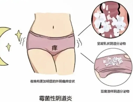 阴道炎