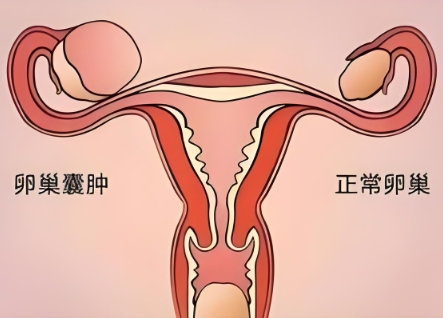 泰安俪人医院卵巢囊肿 泰安俪人医院卵巢囊肿