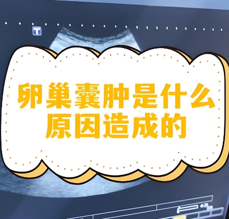 卵巢囊肿 卵巢囊肿