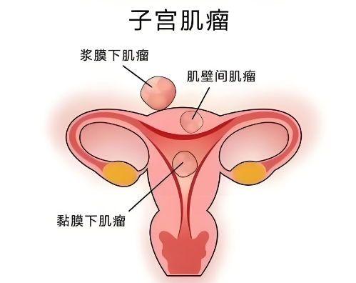 子宫肌瘤 子宫肌瘤