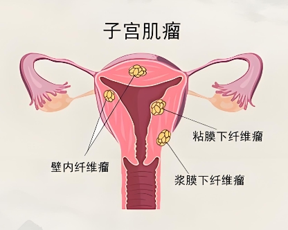 子宫肌瘤 子宫肌瘤