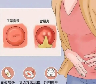 女性阴道炎 女性阴道炎