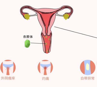 阴道炎 阴道炎