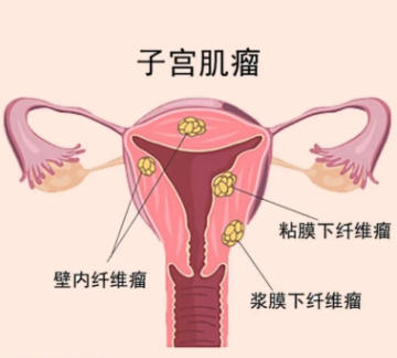 子宫肌瘤